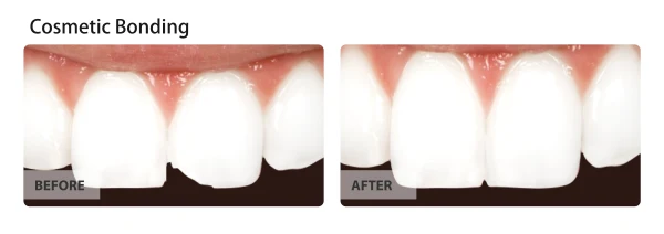 Cosmetic bonding, before and after