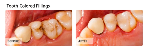 Tooth-colored fillings, before and after