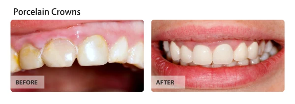 Porcelain crowns, before and after