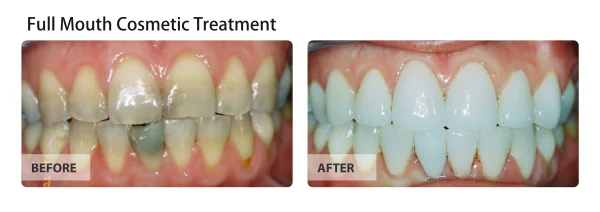 Full mouth cosmetic treatment, before and after
