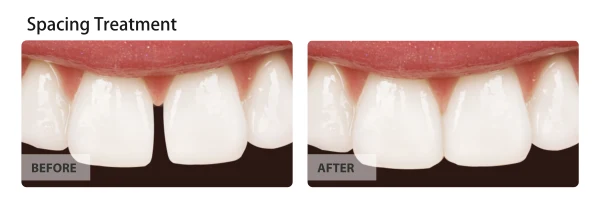Spacing treatment, before and after