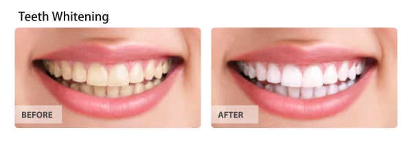 Teeth whitening, before and after